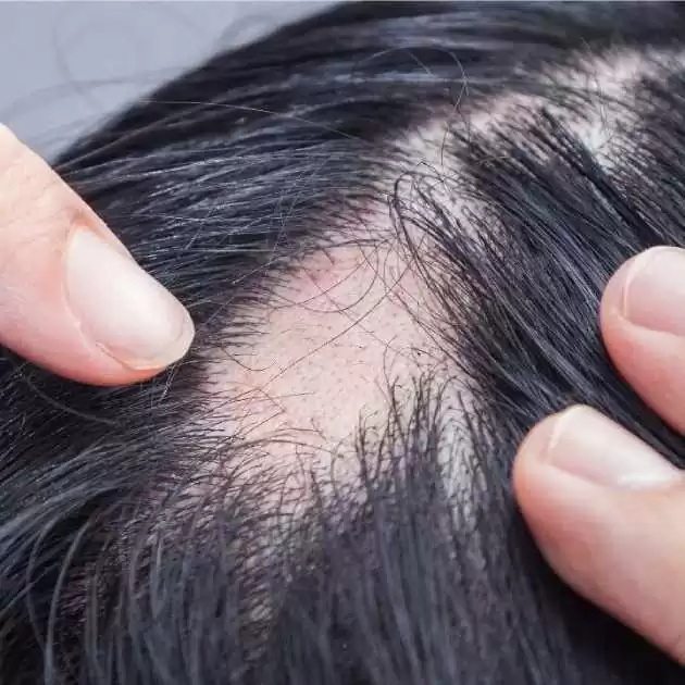 تساقط الشعر